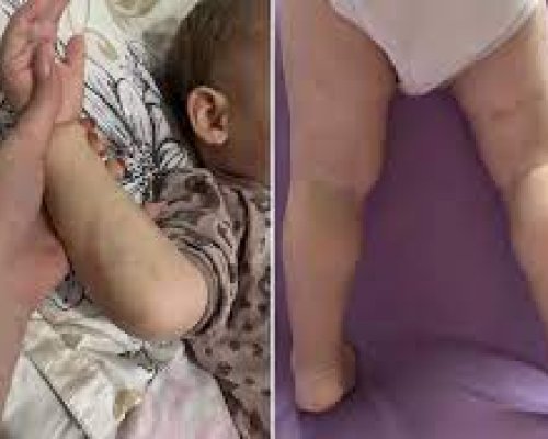 Родители твърдят, че детето им е малтретирано в детска ясла