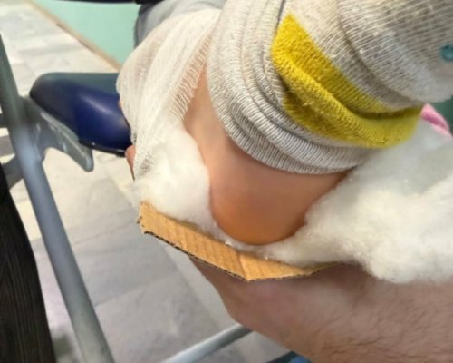 Само за седмица в Разлог: Обездвижиха счупените крайници на две деца с картон от пица