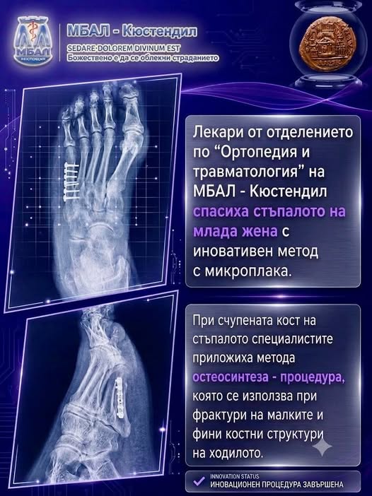Ортопед-травматолозите в Кюстендил спасиха стъпалото на млада жена с иновативен метод с микроплака Ортопед-травматолозите в Кюстендил спасиха стъпалото на млада жена с иновативен метод с микроплака