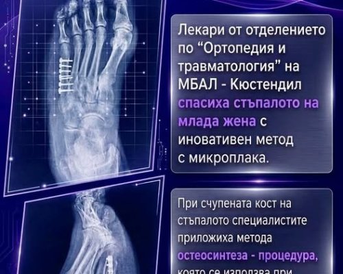 Ортопед-травматолозите в Кюстендил спасиха стъпалото на млада жена с иновативен метод с микроплака